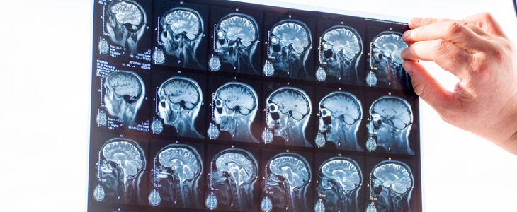 Doctor examining a patient's brain injury scan results